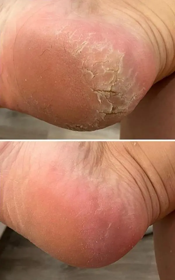 Plástica dos Pés — Tratamento estético avançado que transforma a aparência dos pés. Combate calosidades, rachaduras e promove uma renovação completa — para pés que parecem renascidos.